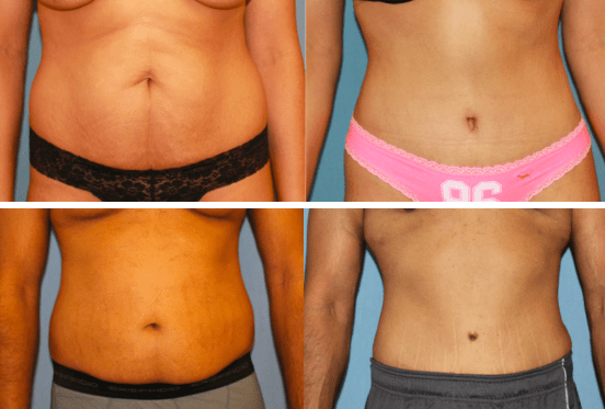 Tummy Tuck Beverly Hills - Ideal Face & Body
